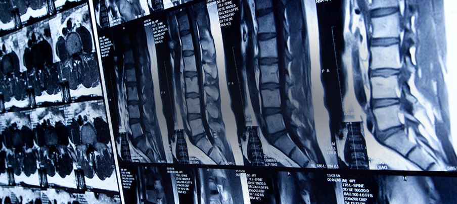Spinal Cord Injuries