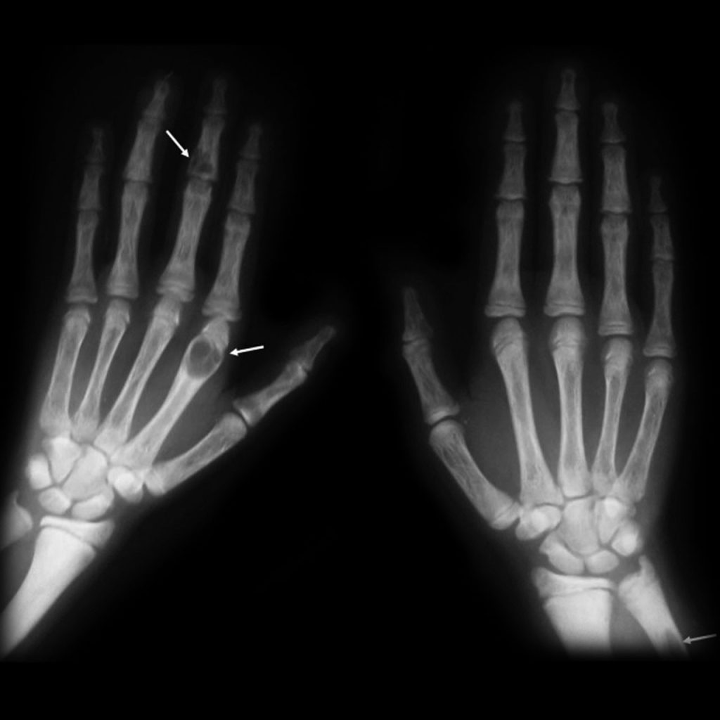 X-ray of two human hands showing bone structure; arrows point to potential abnormalities or lesions in the left hand's fingers and right hand's little finger.